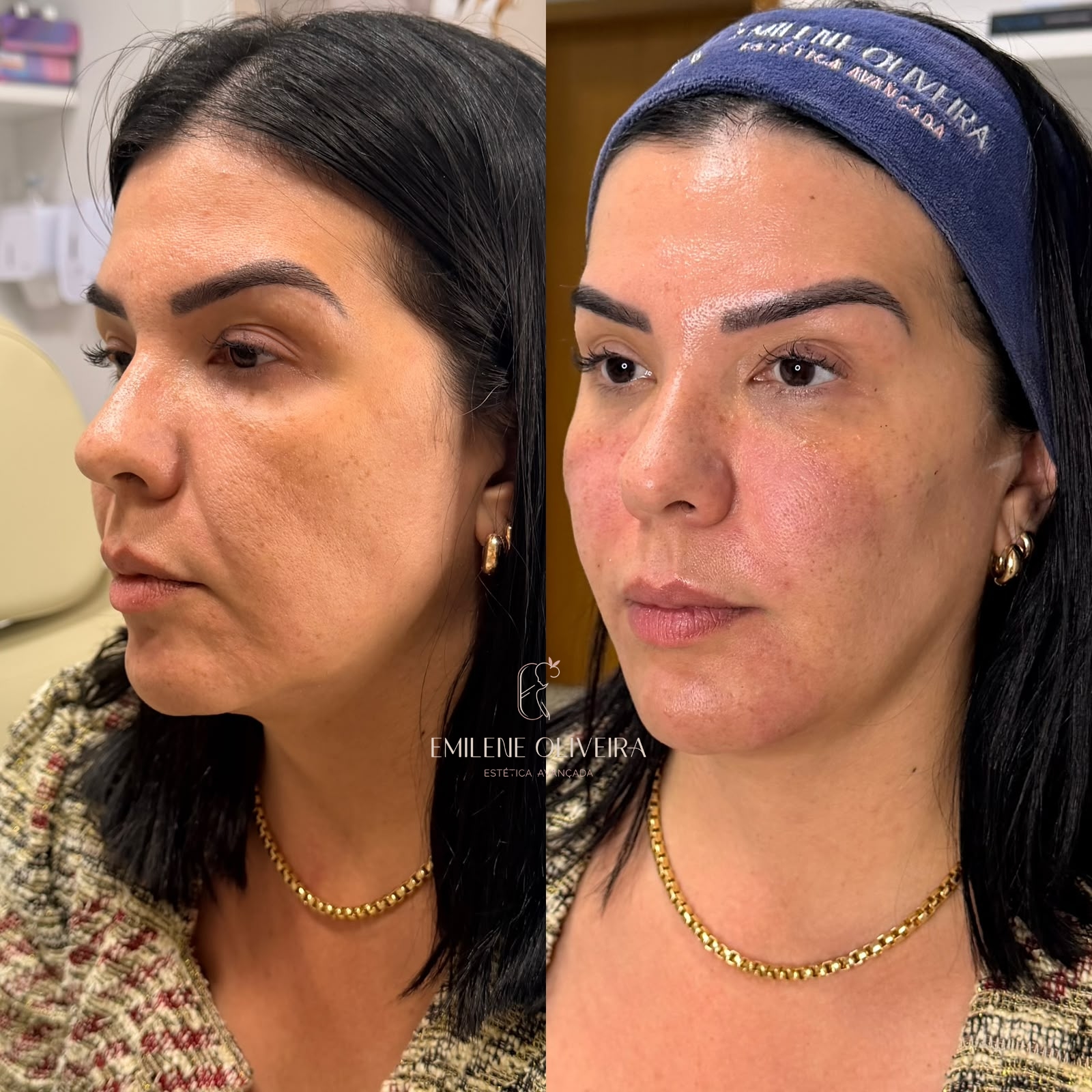 Antes e depois de harmonização facial, vista lateral