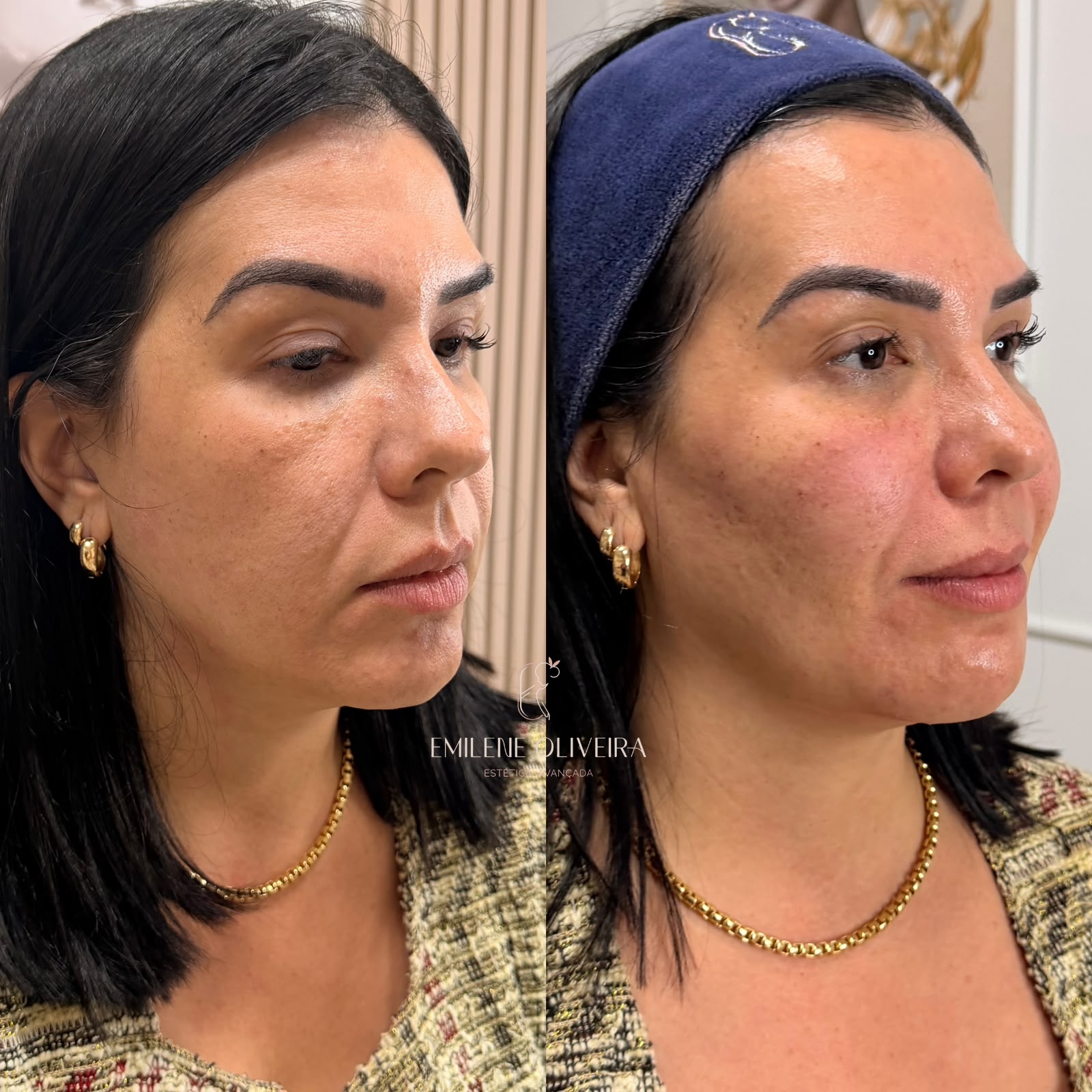 Antes e depois de harmonização facial, vista de três quartos