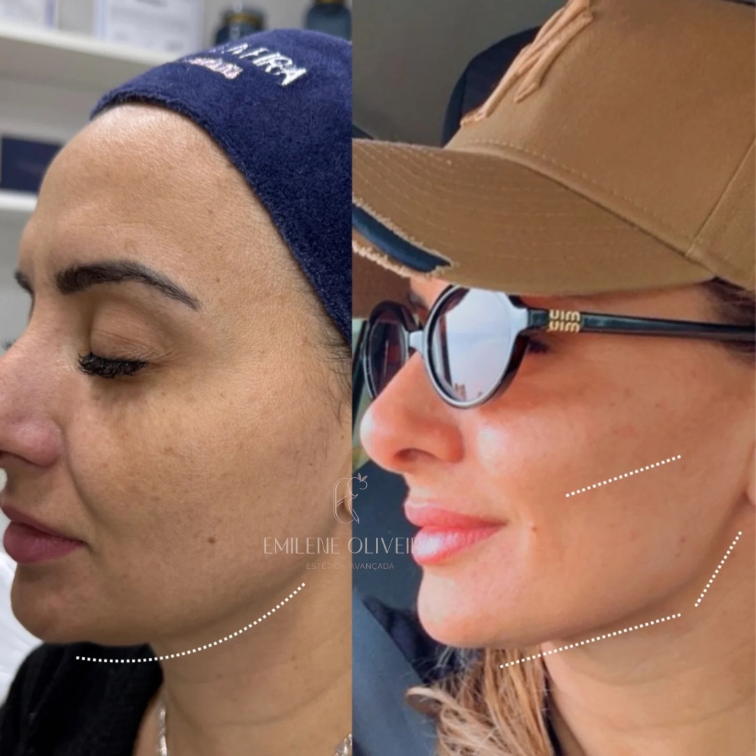 Antes e depois de harmonização facial de perfil, vista lateral