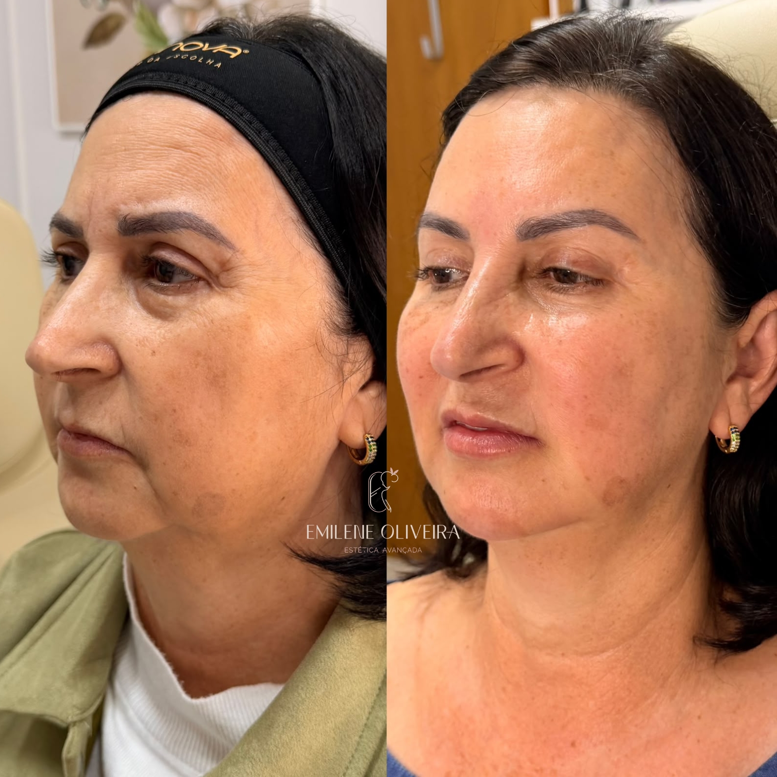 Antes e depois de rejuvenescimento facial, vista lateral