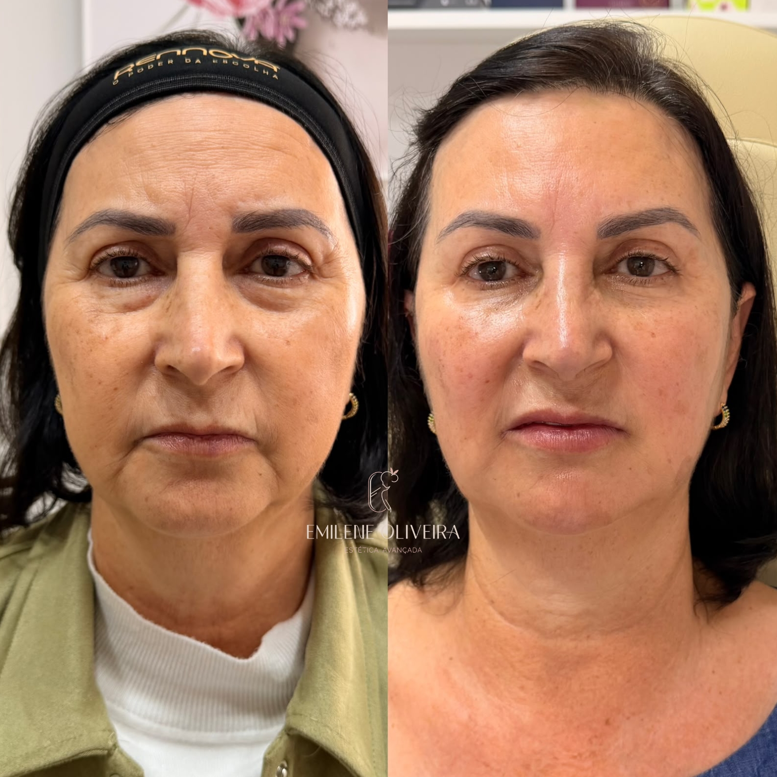 Antes e depois de harmonização facial, vista frontal