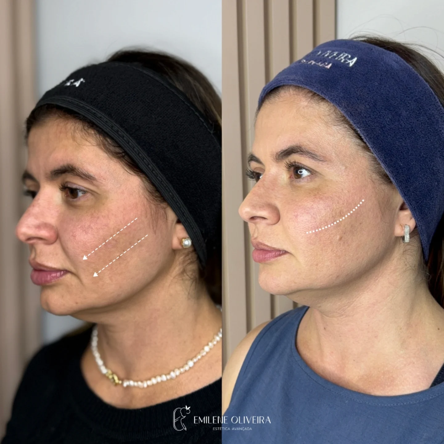 Antes e depois de harmonização do perfil facial