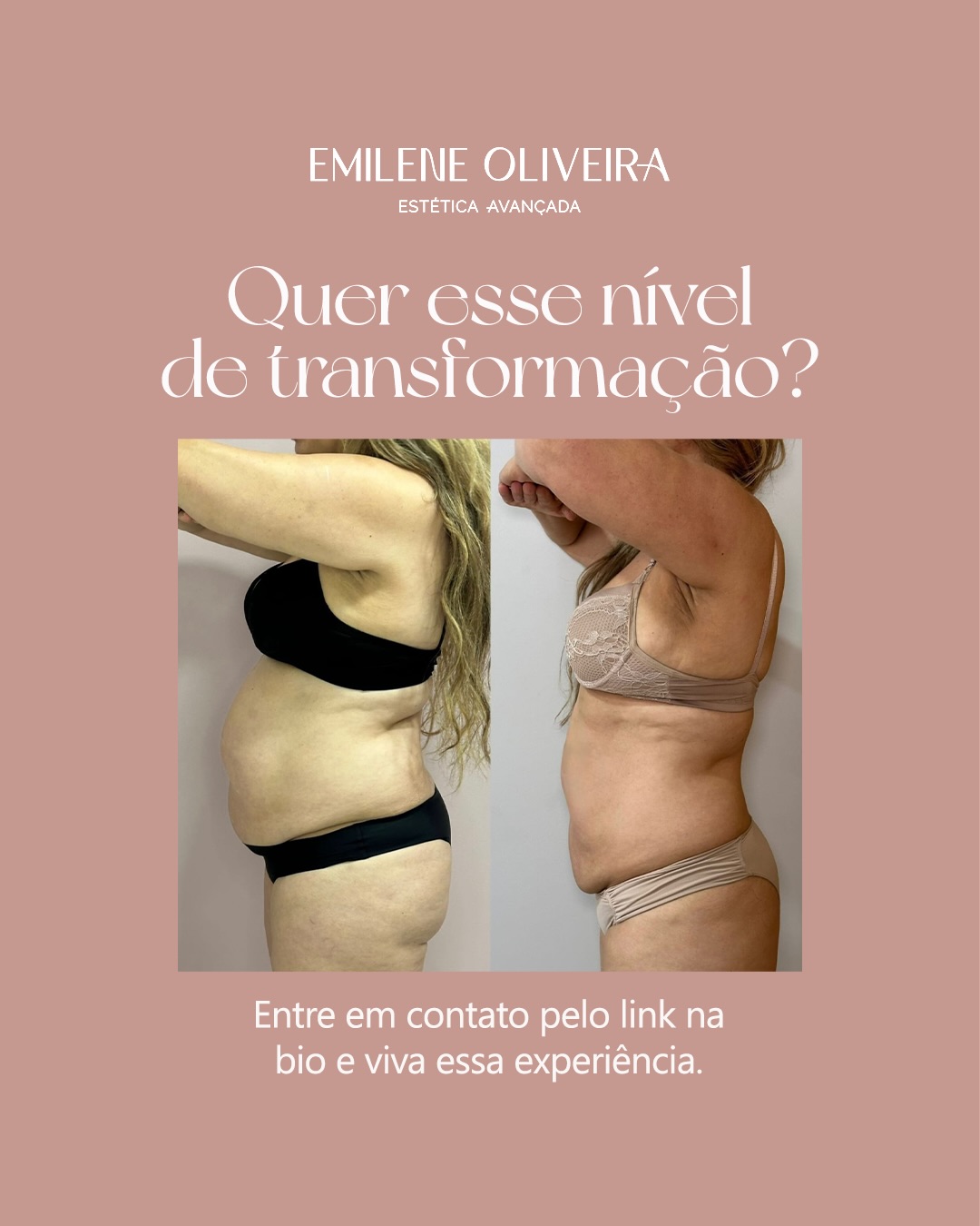 Antes e depois de harmonização corporal: vista lateral do perfil