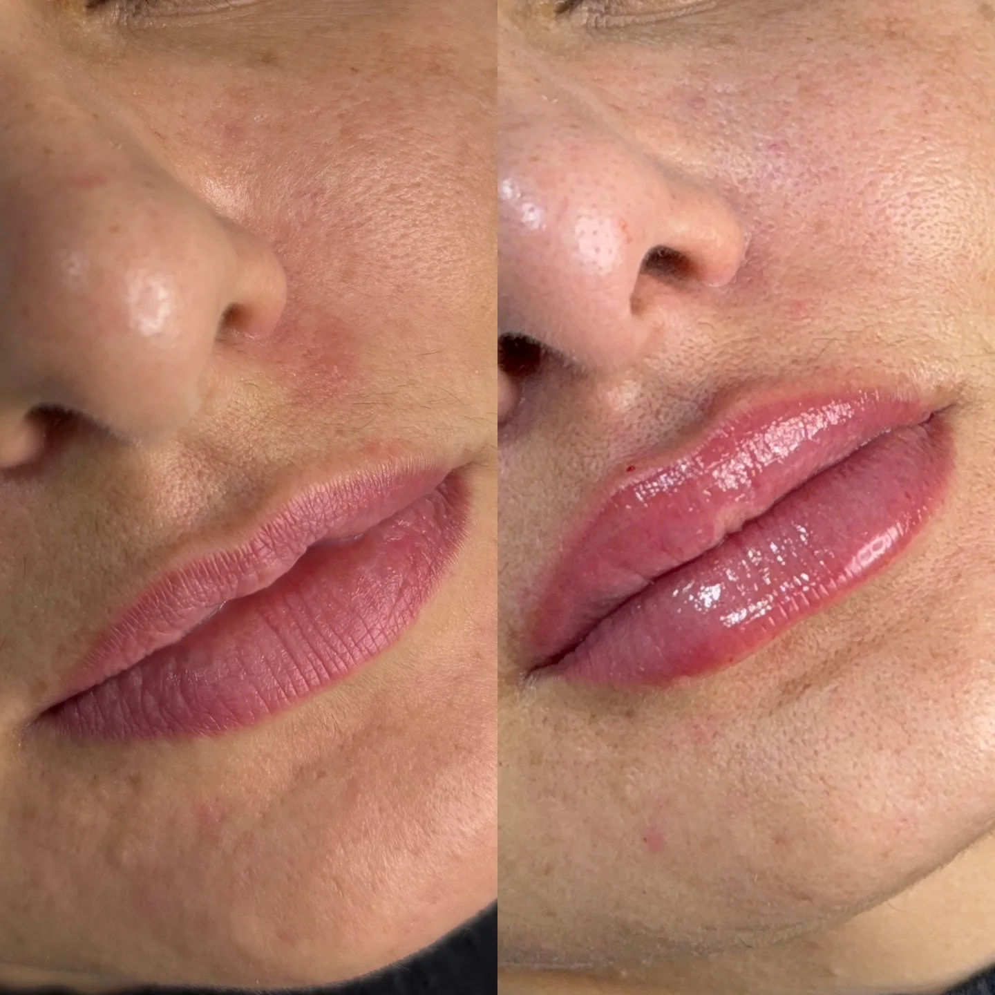 Antes e depois de aumento labial natural