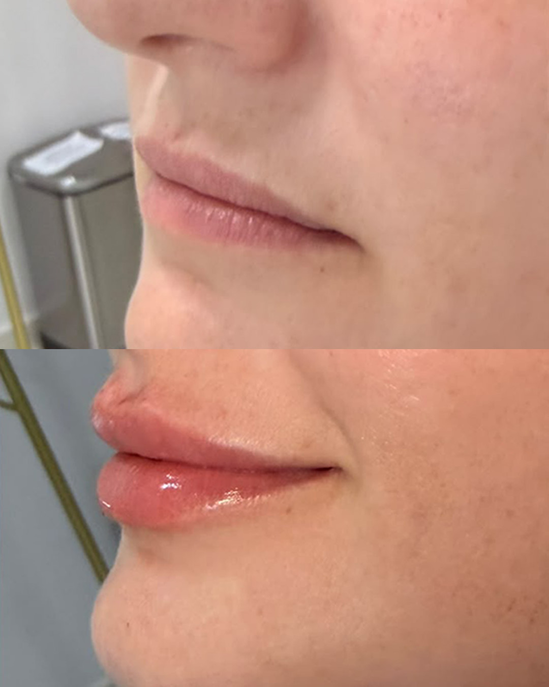 Antes e depois de cuidado labial: volume e definição naturais