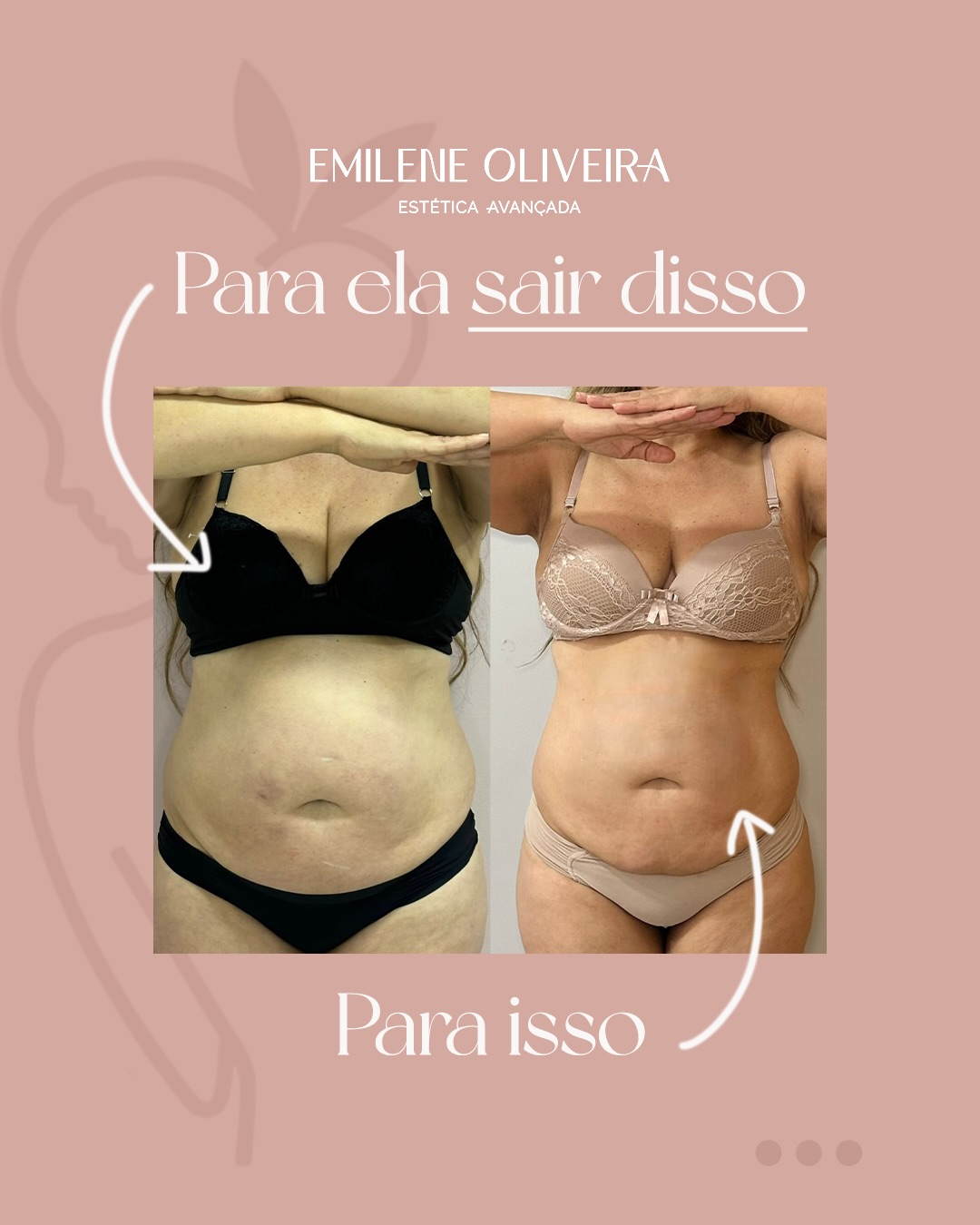 Antes e depois de harmonização corporal: vista frontal do abdômen e do contorno