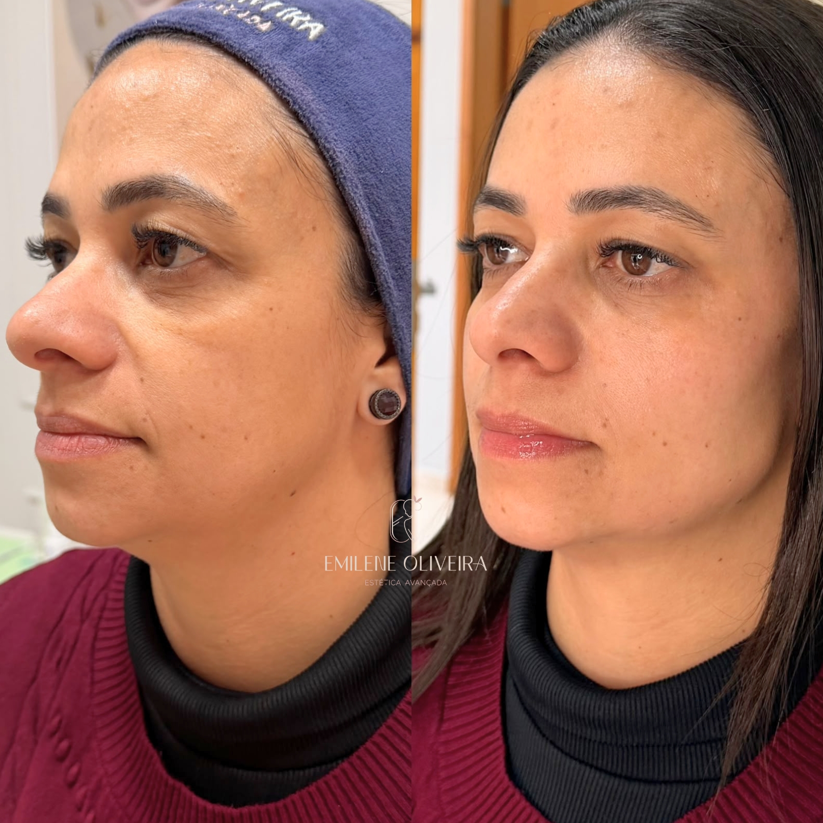 Antes e depois de cuidado facial: contorno e vitalidade da pele